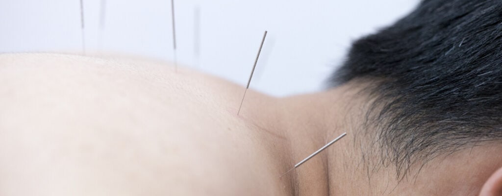 Acupuncture