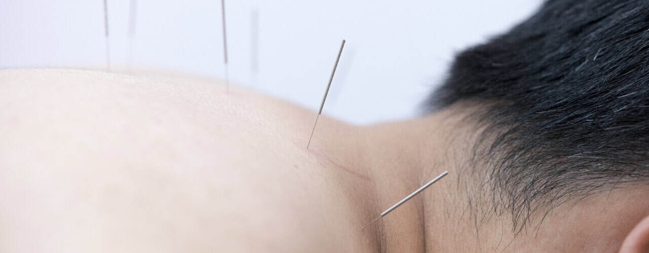 Acupuncture