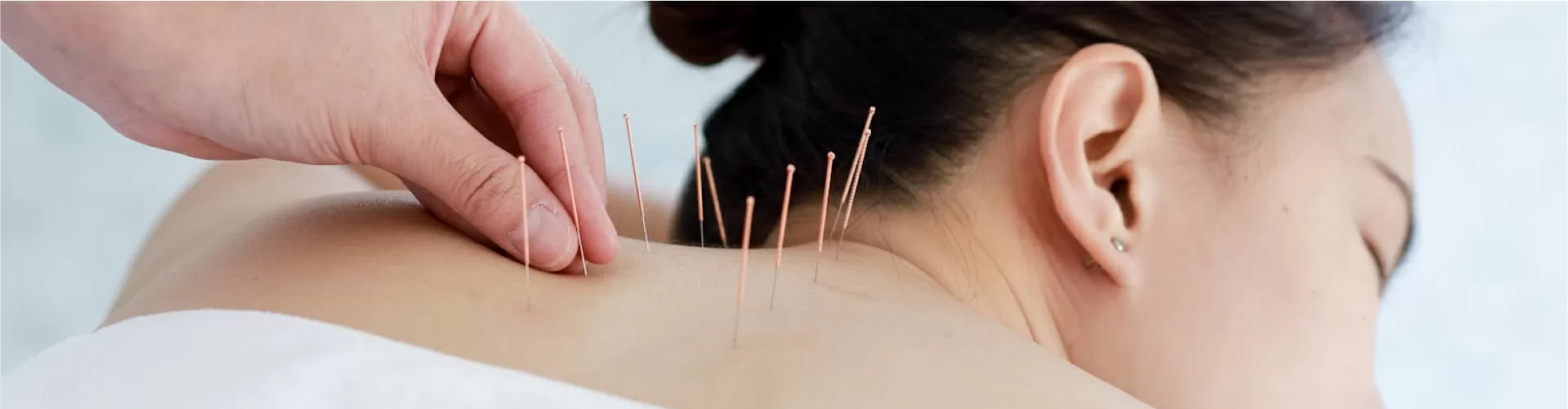 Dry Needling